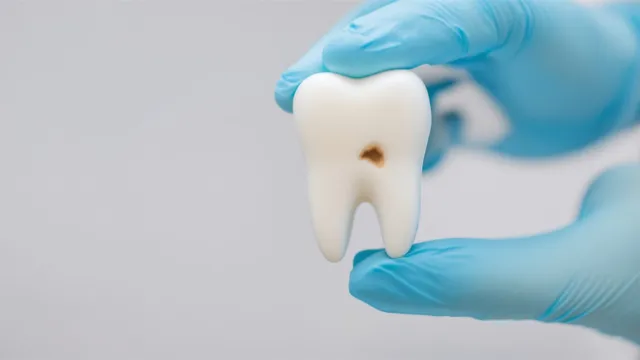 نموذج سن يُظهر تسوساً، ممسوك بيد مرتدية قفازاً